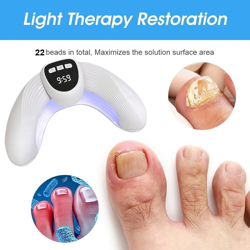 Laser Nail Fungus Treatment Device – Removes Toenail & Fingernail Fungus, Effective Onychomycosis Cure for Fungal Infections Sweet T 52