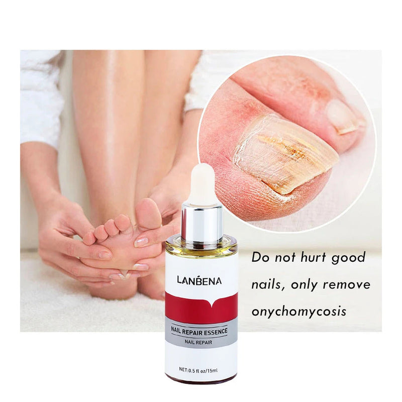 LANBENA 15ml Nail Repair Essence Serum Anti Infection Paronychia Onychomycosis Treatment Foot Care Nail Fungus Removal Gel Sweet T 52