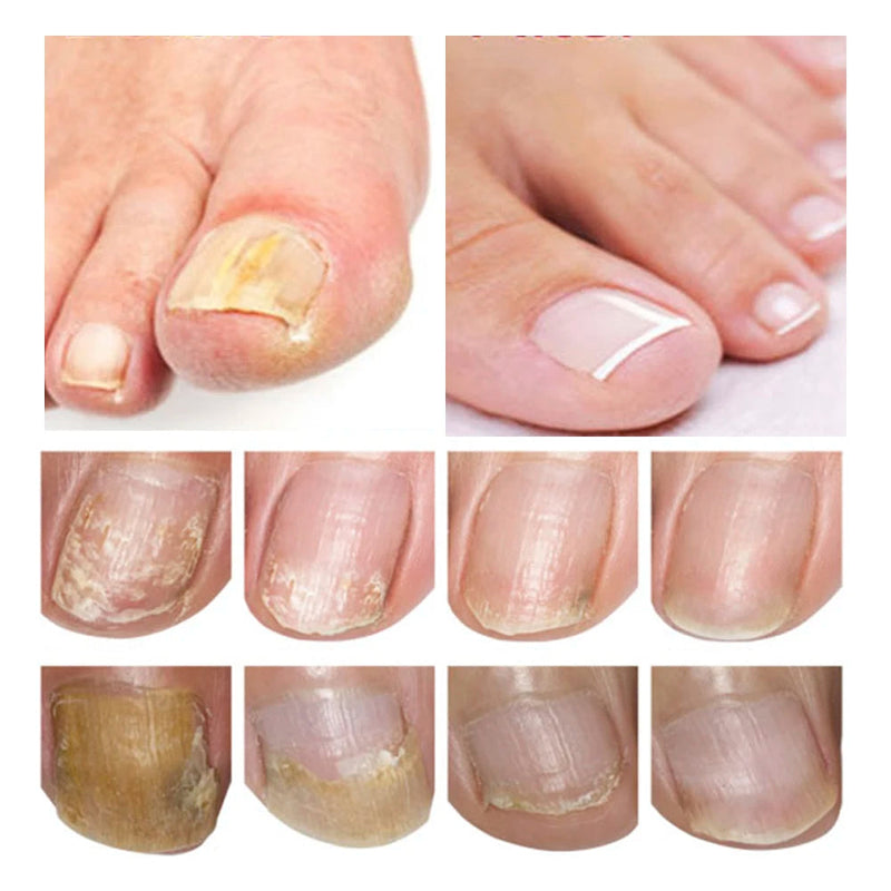 LANBENA 15ml Nail Repair Essence Serum Anti Infection Paronychia Onychomycosis Treatment Foot Care Nail Fungus Removal Gel Sweet T 52