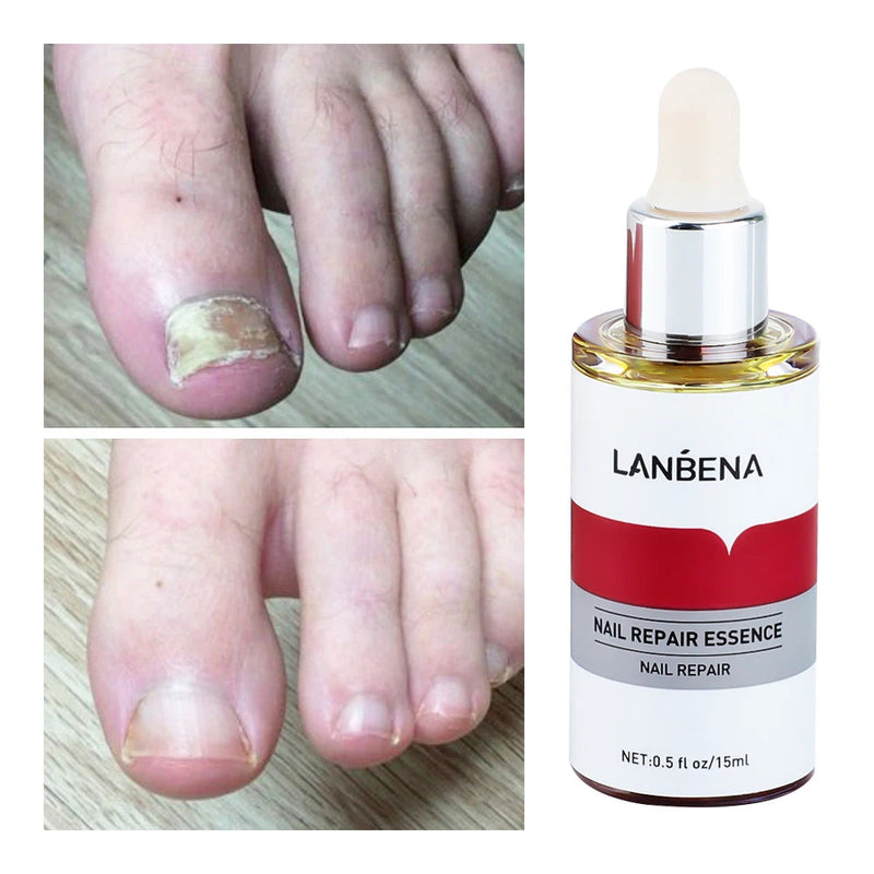 LANBENA 15ml Nail Repair Essence Serum Anti Infection Paronychia Onychomycosis Treatment Foot Care Nail Fungus Removal Gel Sweet T 52