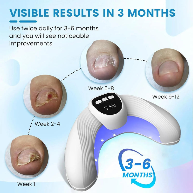 Laser Nail Fungus Treatment Device – Removes Toenail & Fingernail Fungus, Effective Onychomycosis Cure for Fungal Infections Sweet T 52