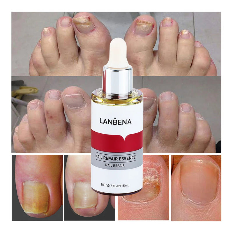 LANBENA 15ml Nail Repair Essence Serum Anti Infection Paronychia Onychomycosis Treatment Foot Care Nail Fungus Removal Gel Sweet T 52