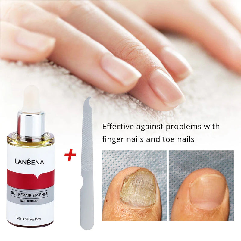 LANBENA 15ml Nail Repair Essence Serum Anti Infection Paronychia Onychomycosis Treatment Foot Care Nail Fungus Removal Gel Sweet T 52