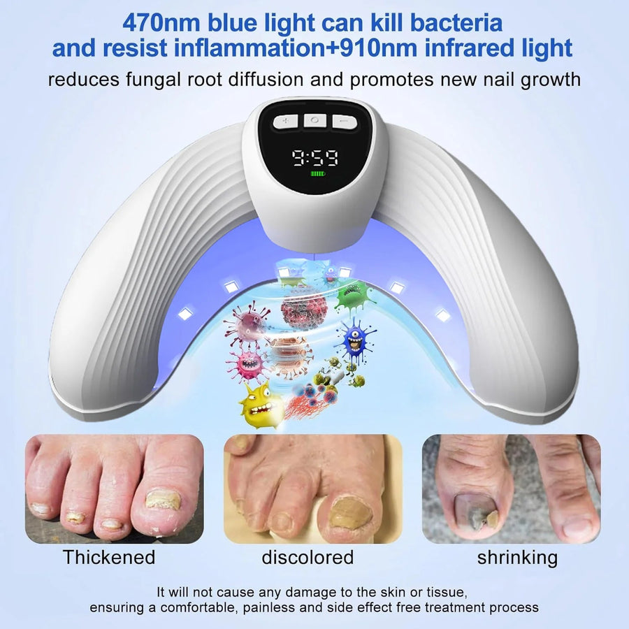 Laser Nail Fungus Treatment Device – Removes Toenail & Fingernail Fungus, Effective Onychomycosis Cure for Fungal Infections Sweet T 52